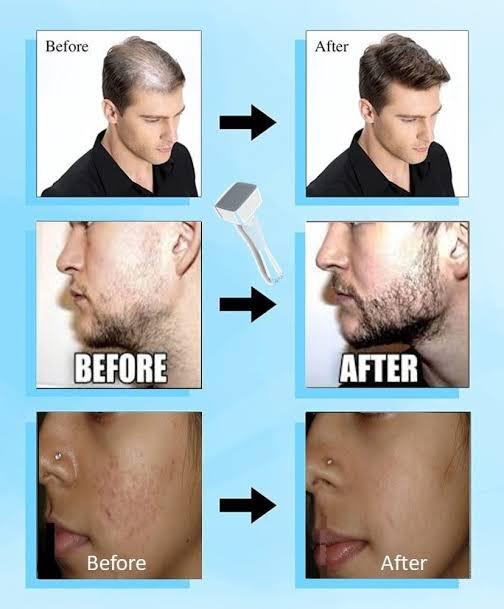 Derma Stamp Micro Needling Tool